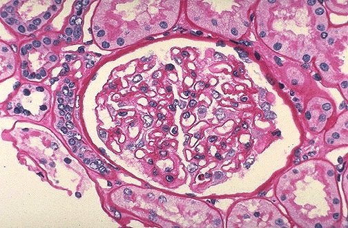 Glomerular Diseases